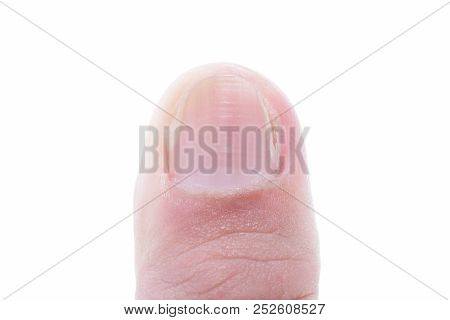 Symptom Of Fungi Infestation On Thumbnail After Cured, The Good Nail Growth, Thumb Isolated On White