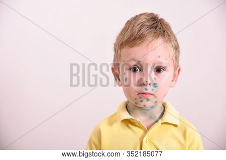 Young Toddler,boy With Chickenpox. Sick Child With Chickenpox. Varicella Virus Or Chickenpox Bubble
