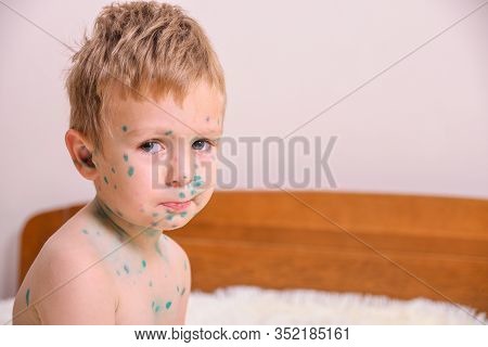 Young Toddler,boy With Chickenpox. Sick Child With Chickenpox. Varicella Virus Or Chickenpox Bubble