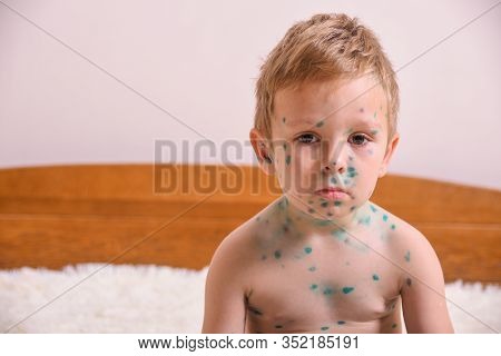 Young Toddler,boy With Chickenpox. Sick Child With Chickenpox. Varicella Virus Or Chickenpox Bubble