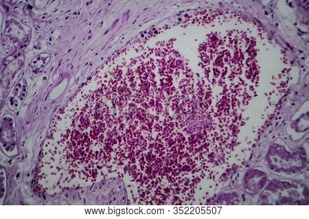 Acute Glomerulonephritis, Light Micrograph, Photo Under Microscope