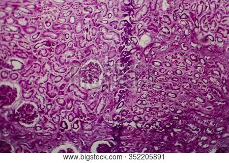Histopathology Of Diffuse Sclerosing Glomerulonephritis, Light Micrograph, Photo Under Microscope