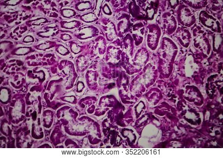 Histopathology Of Diffuse Sclerosing Glomerulonephritis, Light Micrograph, Photo Under Microscope