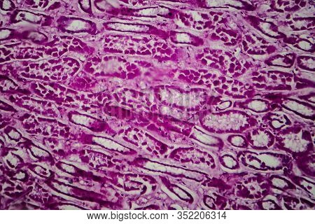 Histopathology Of Diffuse Sclerosing Glomerulonephritis, Light Micrograph, Photo Under Microscope