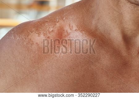 Sunburn On The Shoulders Of Men. Shoulders With A Hurt Skin Fron Sun Burn, Closeup