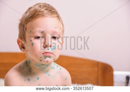 Young Toddler,boy With Chickenpox. Sick Child With Chickenpox. Varicella Virus Or Chickenpox Bubble