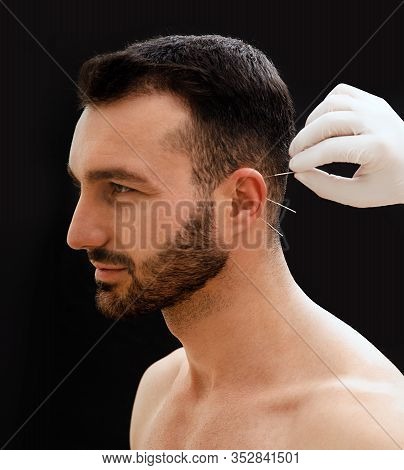 Treatment Of Many Diseases By Ear Acupuncture. Acupuncturist Treats A Patients Illness With Acupunct