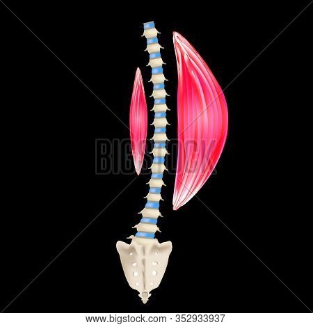 Left-sided Scoliosis. Levoscoliosis. Muscles And Spine. Spinal Curvature In Scoliosis. Infographics.