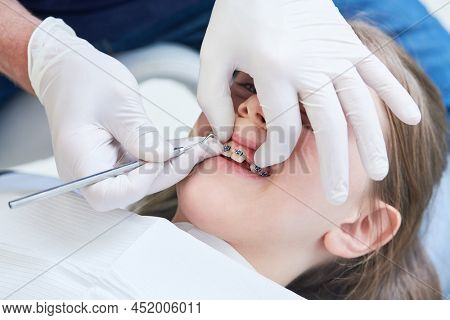 Braces for child teeth correction. Installation and maintenace
