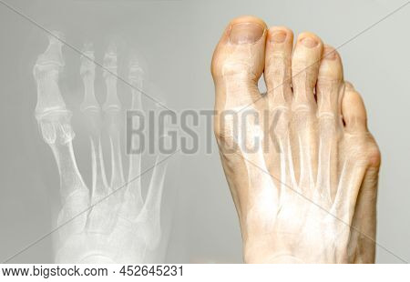 X-ray And The Same Foot. Hallux Varus Condition.