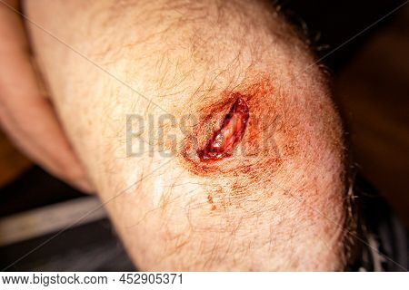 Open Wound On Knee. Blood Comes From A Wound On The Leg, Close-up, Cut Leg