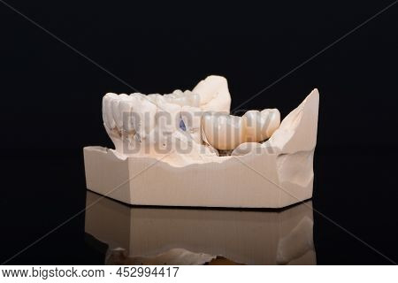 Plaster Lower Jaw Model With Zirconia Teeth On Implants. Process Of Manufacturing Ceramic Teeth On I