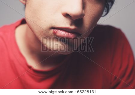 Man With Cold Sore