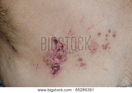 Herpes Zoster