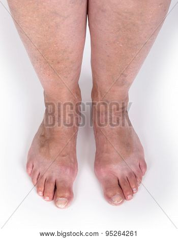 Old Woman With Varicose Veins