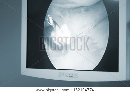 Arthroscopy Surgery Screen
