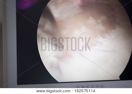 Arthroscopy Surgery Screen
