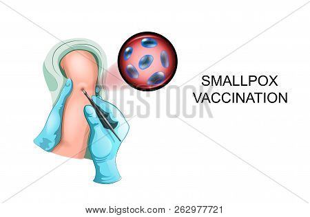 Vector Illustration Of Vaccination Of A Child Against Smallpox