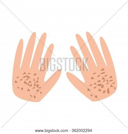 Freckles On The Hands. Pigmentation On The Skin. A Pigmented Spot On The Skin Of The Hands. Vector I