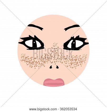 Freckles On The Face. Pigmentation On The Skin. A Pigmented Spot On The Skin Of The Face. Vector Ill