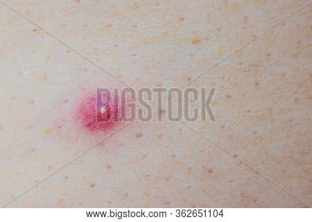 Close Up Photo Of Nodular Cystic Acne Skin. Chronic Acne Skin On Woman Surface.  Woman With Acne Pro