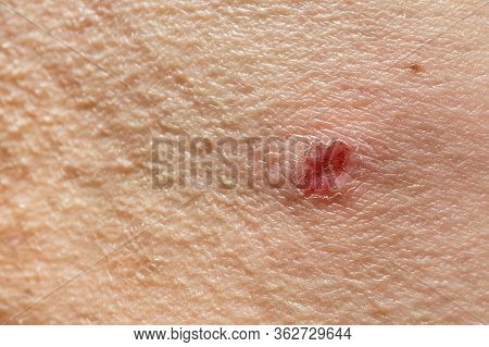 Itchy Skin.torn Skin At The Site Of Inflammation. Peeling And Combing Of The Skin With Various Skin 
