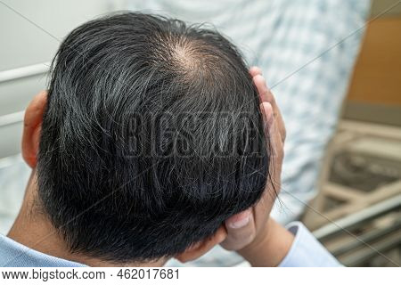 Bald In The Middle Head And Begin No Loss Hair Glabrous Of Mature Asian Business Smart Active Office