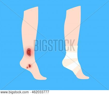 Sore, Cut Or Ulcer On Human Leg. Elastic Bandage, Wrap Medical Gauze Over Foot. Healthcare Concept. 