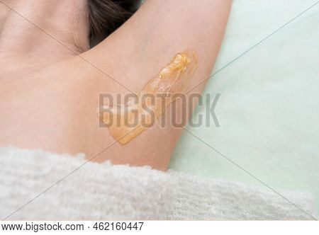Depilation And Epilation Of The Female Armpit With Liquid Sugar Paste. Sugar Paste Applied To The Ar