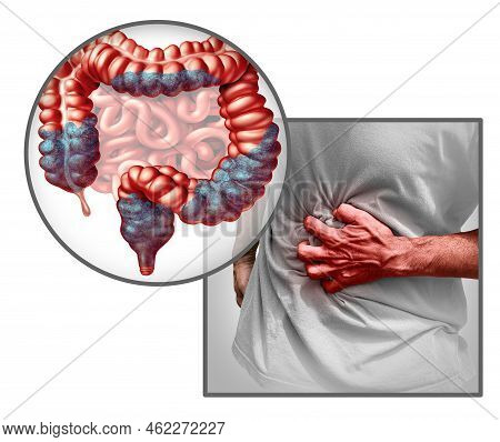 Constipation Anatomy And Constipated Symptoms As Stool Bowel Movement Problem As An Intestine And Re