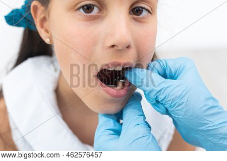 Dentist Is Check And Set Dimension Of Brackets. Talking To Girl About Braces In Her Mouth
