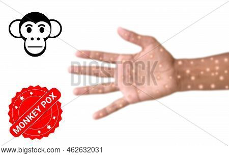 Monkey Pox Label On Blur Infected Hand.  Monkey Pox Awareness Illustration Image.