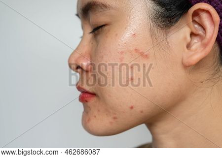 Close Up Of Asian Woman Having Acne Inflamed On Her Cheek. Inflamed Acne Consists Of Swelling, Redne