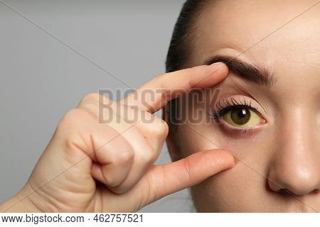 Woman Checking Her Health Condition On Grey Background, Closeup. Yellow Eyes As Symptom Of Problems 