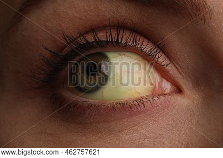 Woman With Yellow Eyes, Closeup. Liver Problems Symptom