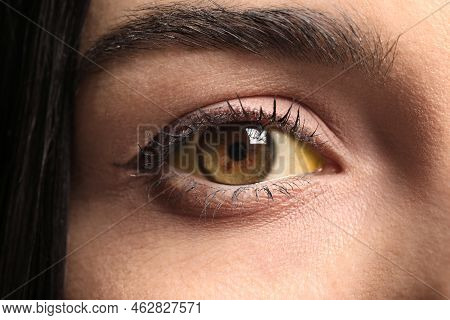 Woman With Yellow Eyes As Background, Closeup. Liver Problems Symptom