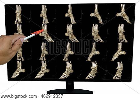 The Doctor Informed The Results Of X-ray Images Of The Ankle And Found Distal Tibia Bone Abnormaliti