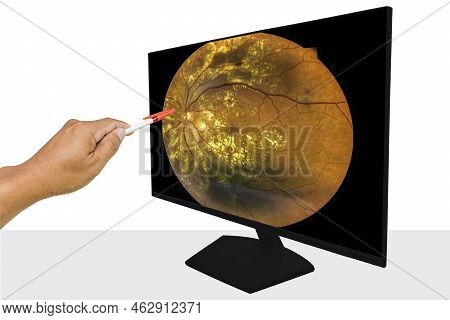 View Inside Human Eye Disorders Showing Retina, Optic Nerve And Macula Severe Age-related Macular De