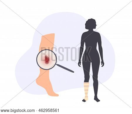 Sore, Cut Or Ulcer On Human Leg. Elastic Bandage, Wrap Medical Gauze Over Foot. Healthcare Concept. 
