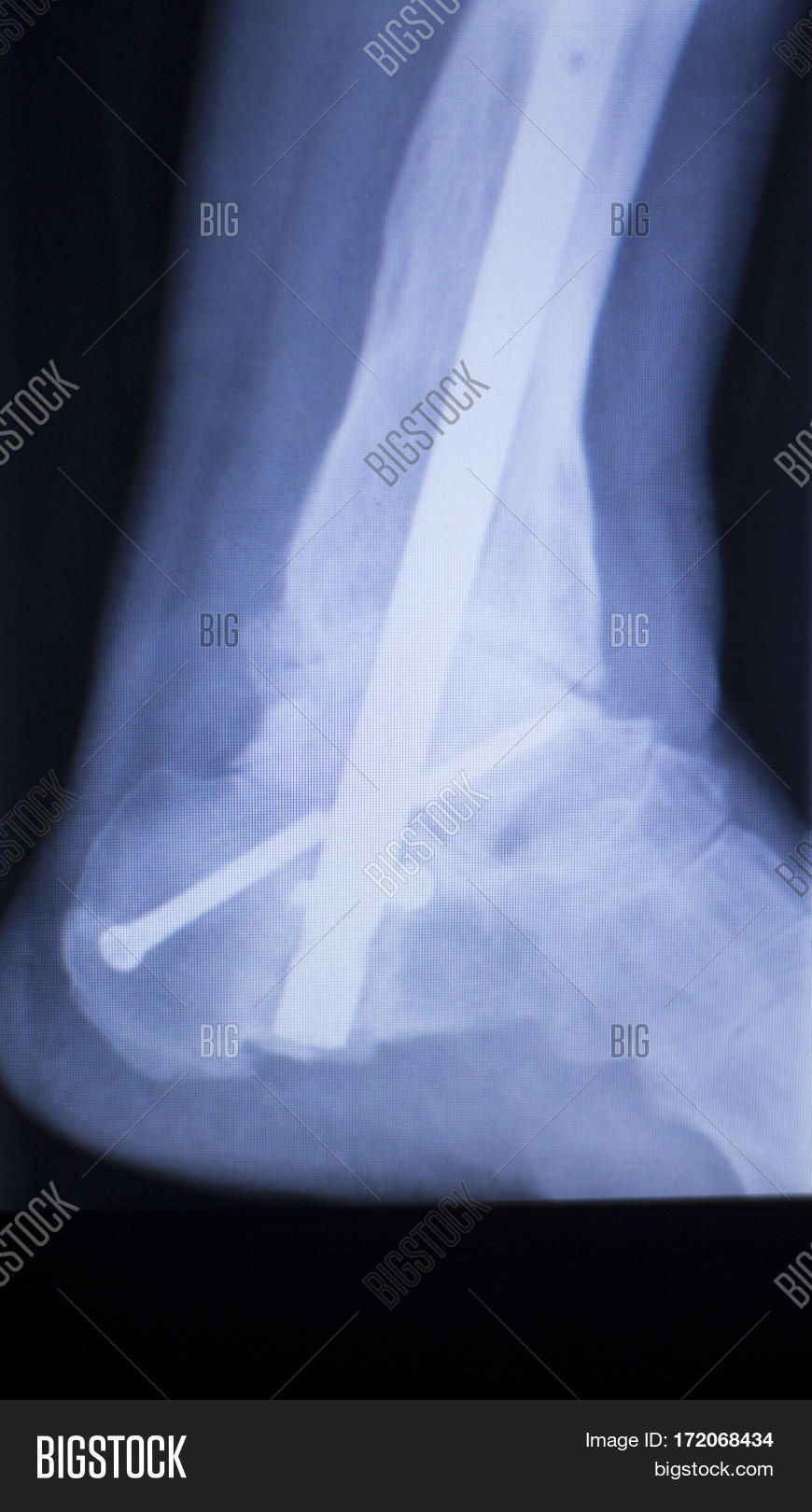 Xray Foot Heel Ankle Image & Photo (Free Trial) Bigstock