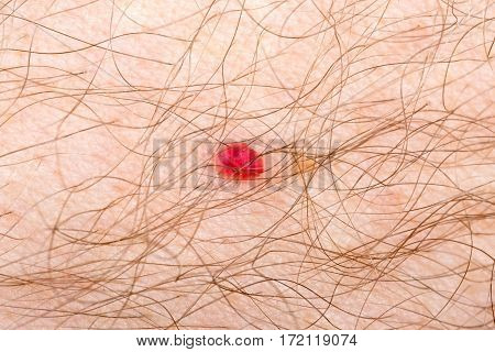 Close up photo of cherry angioma on human skin