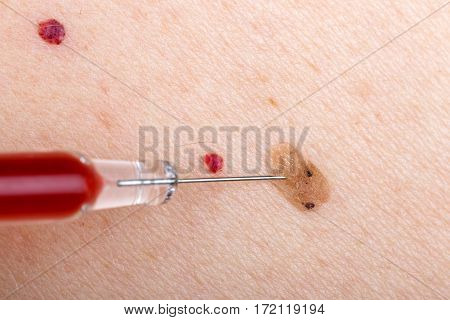 Injection treatment of nevus and cherry angioma