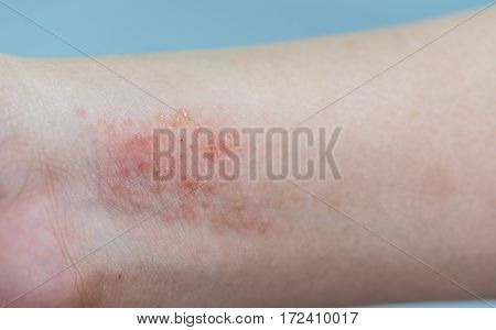 close up of atopic dermatitis symptom skin on hand
