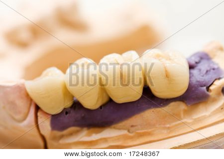 Dental Bridge lavet af porcelæn på Casting