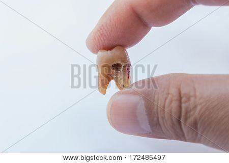 Close-up Tooth decay in hand on a white background.