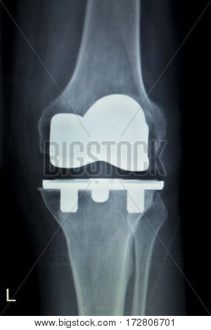 Orthopedic Knee Implant Xray Scan