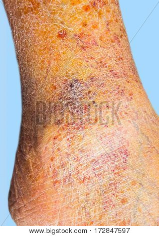 Close-up of skin with varicose veins on senior male leg. Concept of dry skin