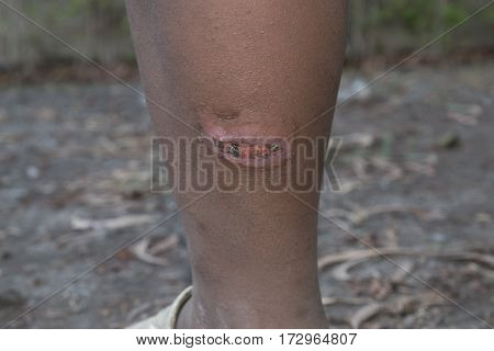 Infected wound on leg. Wounds caused by the heat of the exhaust system.