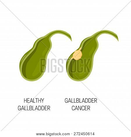 Biliary Tract Disease Concept. Medical Illustration Of Healthy Gallbladder And Gallbladder Cancer. V