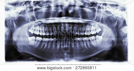 Panoramic Dental X-ray Image Or Orthopantomogram Of Jaw With All Teeth  Used In Dentistry For Diagno